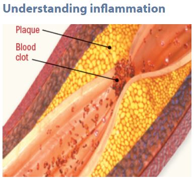 Understanding Inflamation Harvard Health