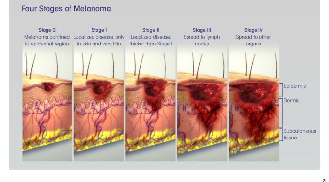 Melanoma: How To Catch Skin Cancer Early (Mayo)
